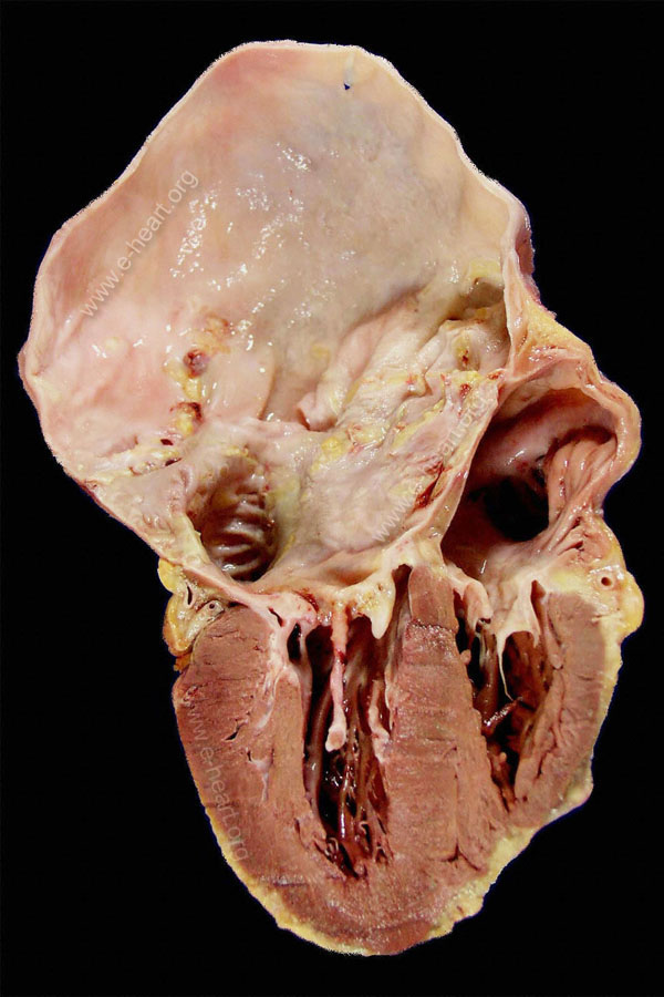 Rheumatic MV Stenosis & LA